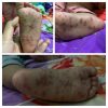 Waspada Virus Singapura (HFMD) Mulai Menyerang Warga Sungai Kecil Desa Sebong Lagoi
