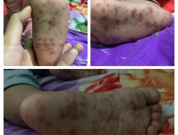 Waspada Virus Singapura (HFMD) Mulai Menyerang Warga Sungai Kecil Desa Sebong Lagoi